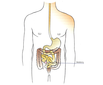 STOMA CARE GUIDE