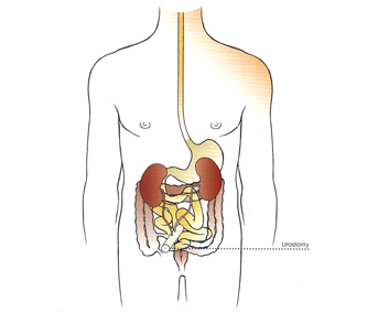 STOMA CARE GUIDE